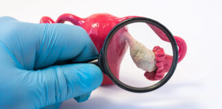 Polikistik Over Sendromu polikistik over sendromu tedavisi kıbrıs