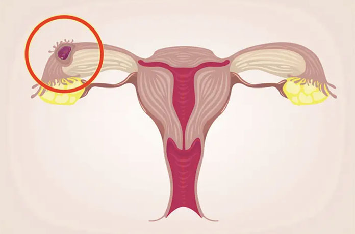 dış gebelik nedir nasıl oluşur dış gebelik nedir nasıl oluşur